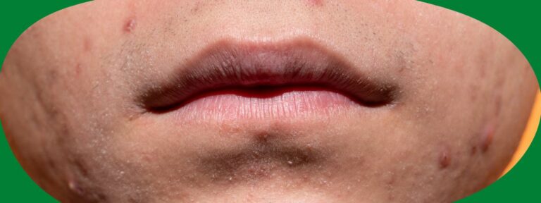 Grain de fordyce levres , comment le combattre ?